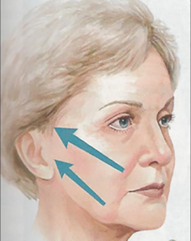 Vectors of pull in a SMAS facelift