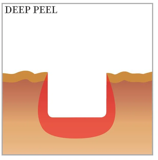 laser resurfacing deep peel