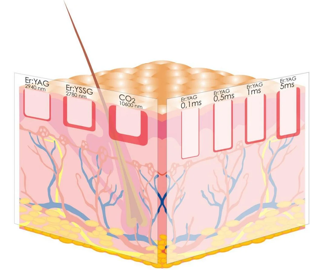 Er:YAG vs CO2 laser tissue effects