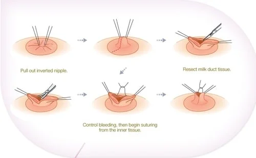 inverted nipple correction procedure