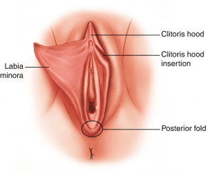 What is Labial Hypertrophy?