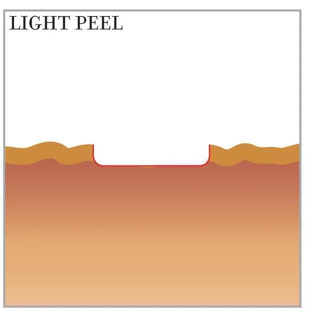 laser resurfacing light peel