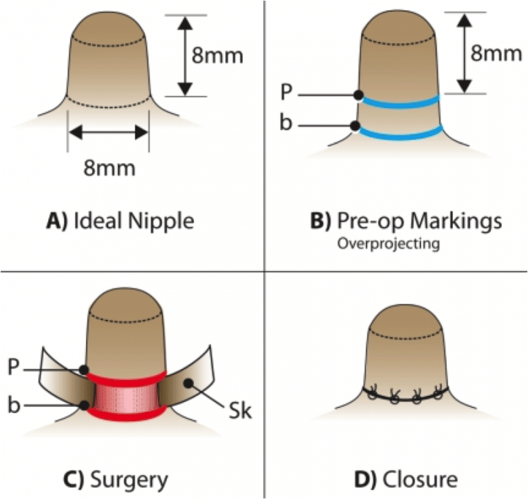 nipple reduction surgical technique