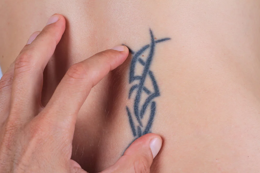 surgical tattoo removal london