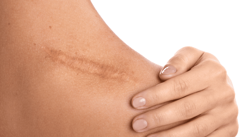 Different Types of Scars and Treatment Options