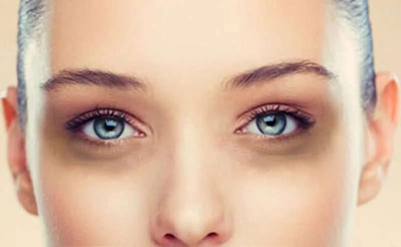 Panda Eyes, Dark Circles Under the Eyes - Causes & Treatment | Centre