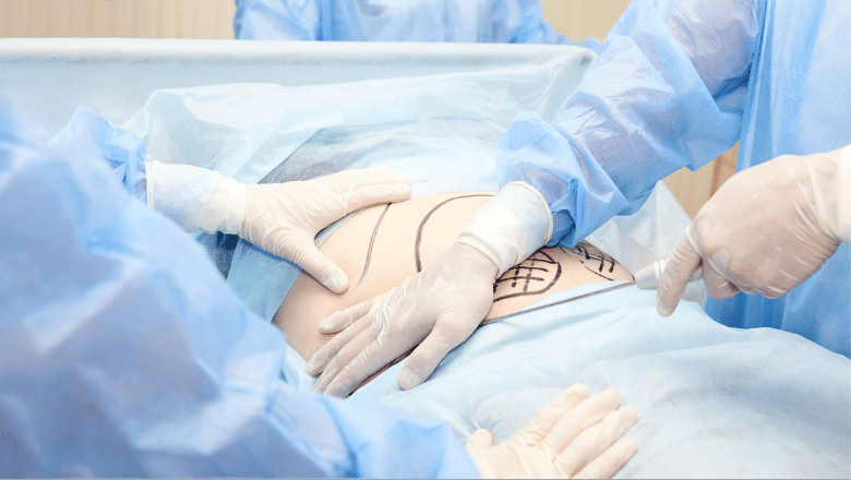 risks of liposuction