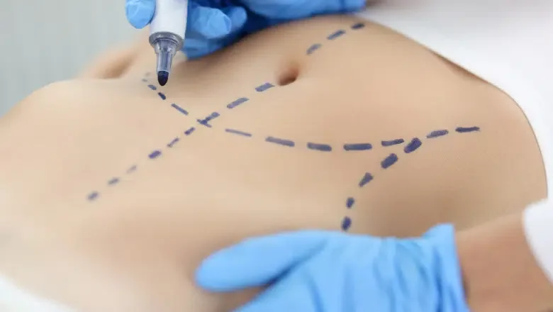 What is a Corset Trunkplasty