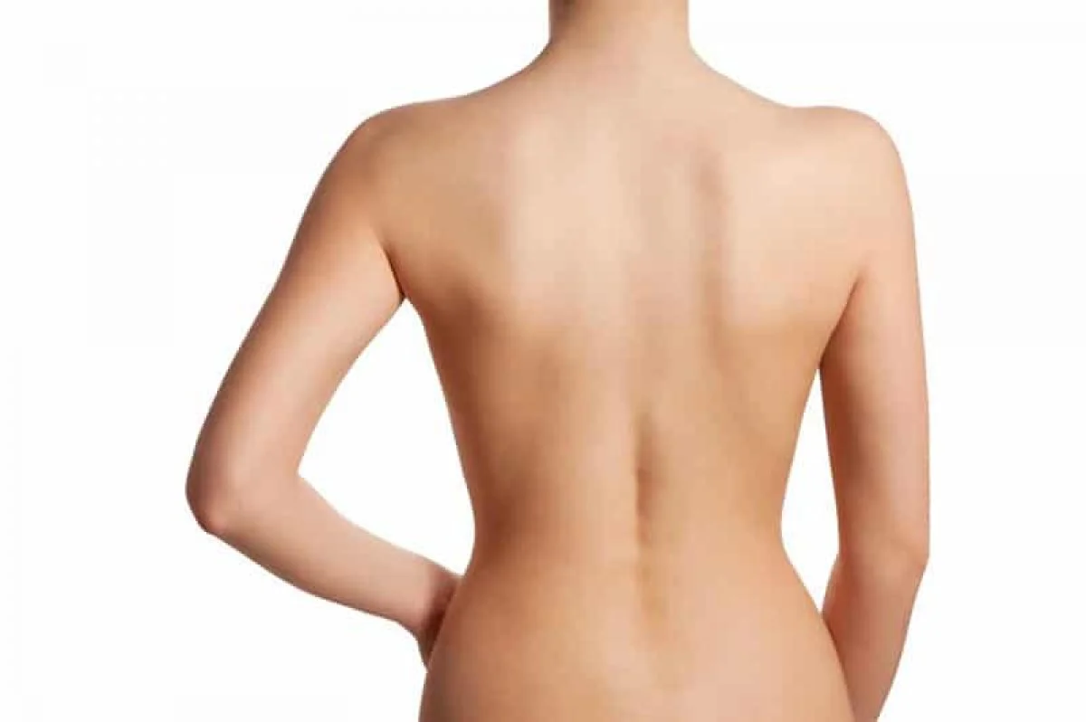 Liposuction of the Back Bra Rolls Beverly Hills - Get a Smoother Back