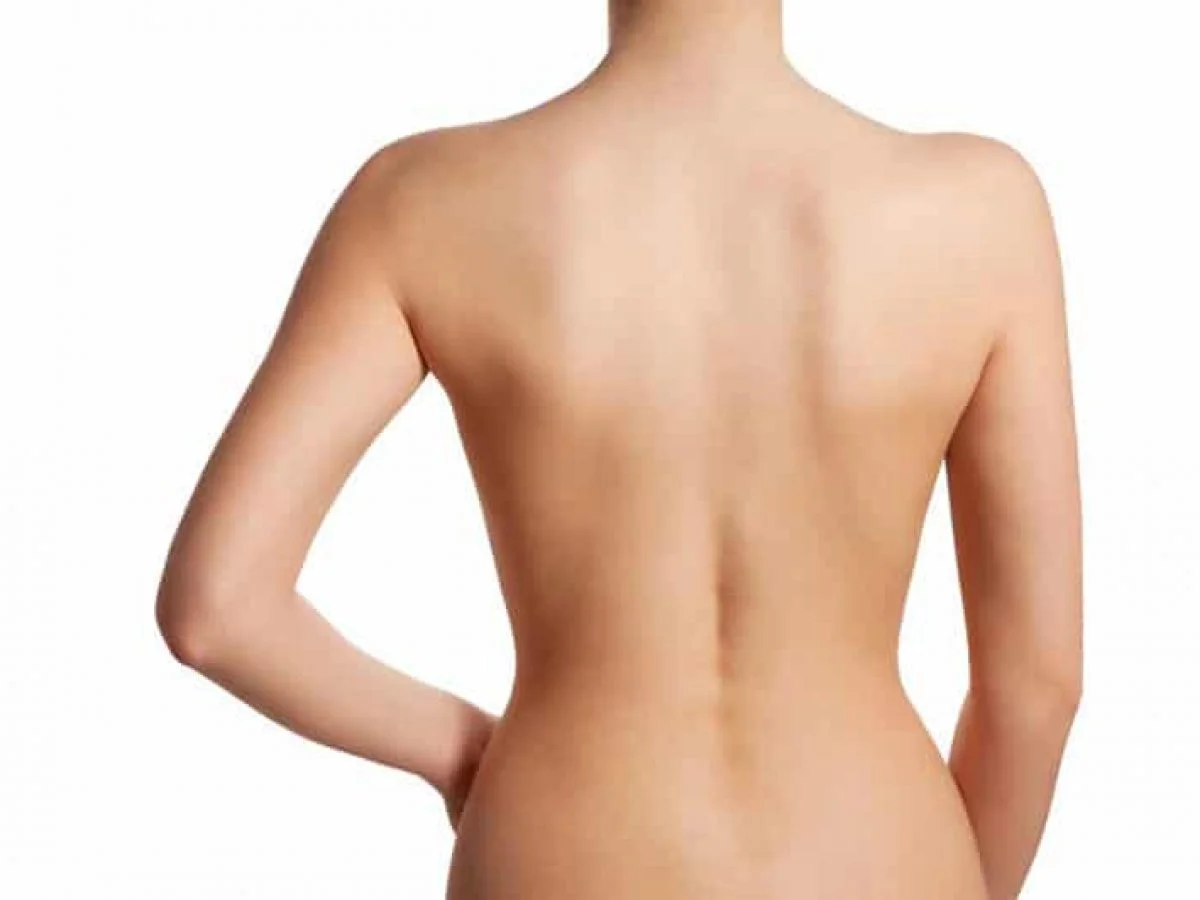 Elimination of back roll following ultrasound-assisted liposuction