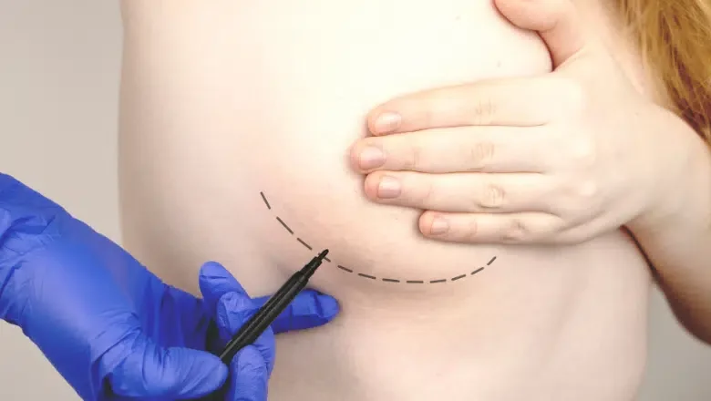 breast augmentation incisions