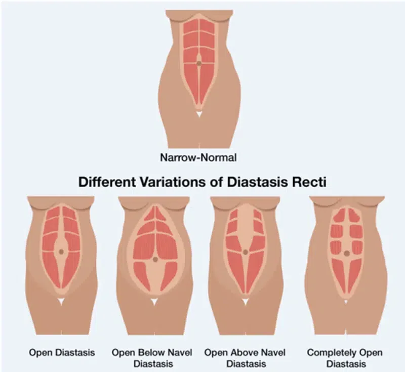 diastasis recti