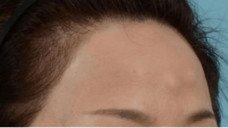 What is forehead osteoma removal?