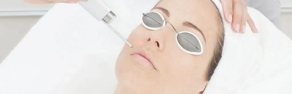 laser-acne-scar-removal