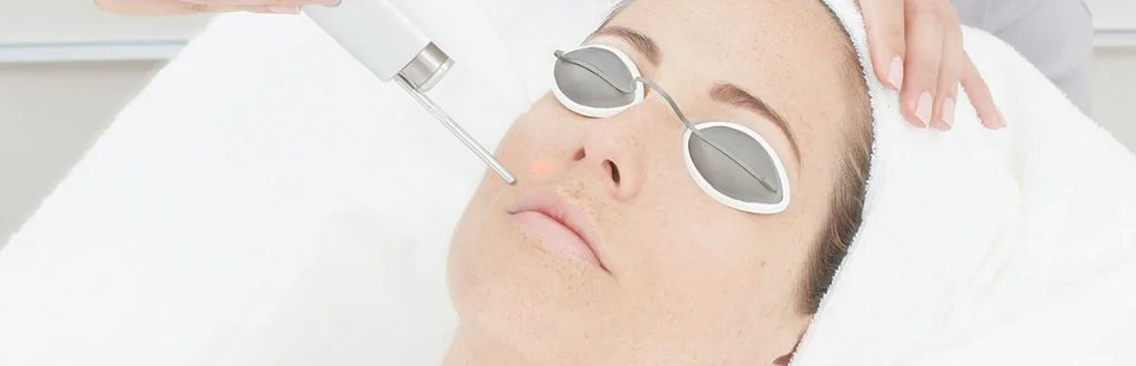 laser-acne-scar-removal