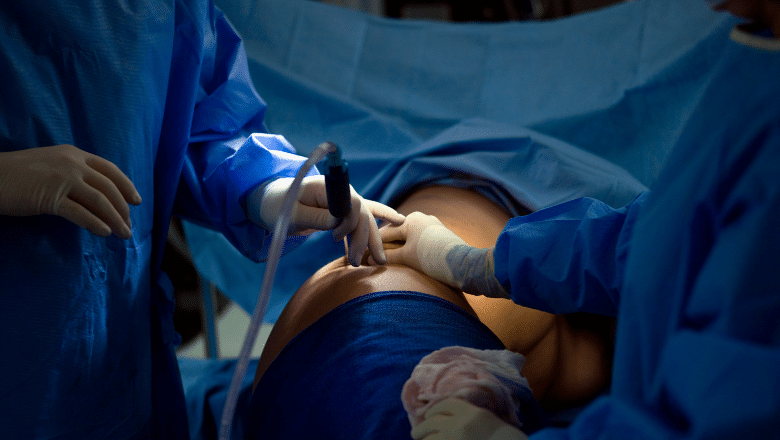 lipoedema liposuction