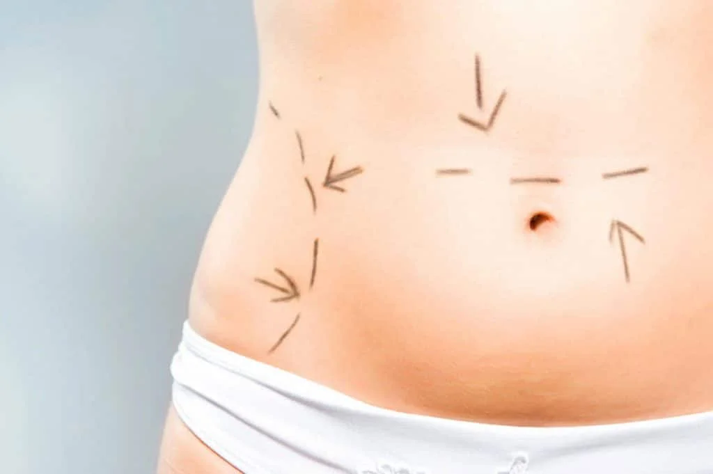 liposuction fat removal london