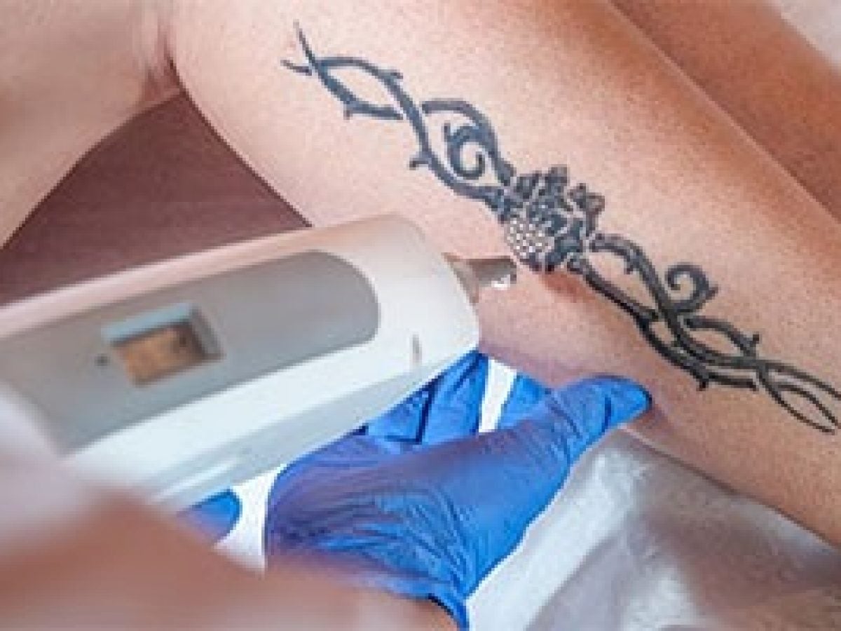 PicoSure Tattoo Removal | Dr. Peter Kay