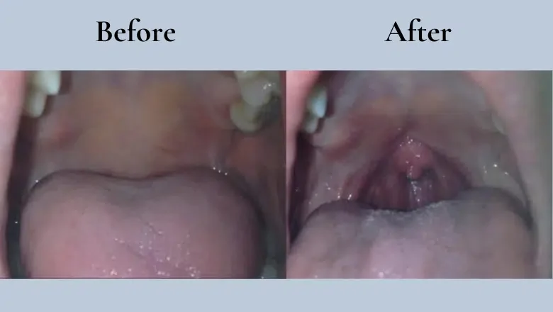 Nightlase-laser-snoring-treatment-before-after-2.png.webp?format=webp&nv=ca64acd6-a6db-44c0-8ef1-3388dfd37a49