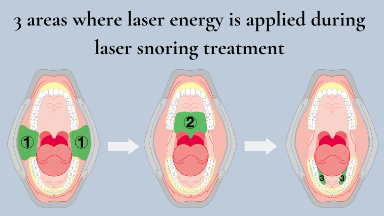 laser snoring treatment areas London UK