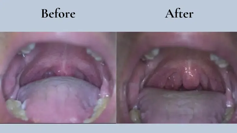 laser snoring treatment before after 1