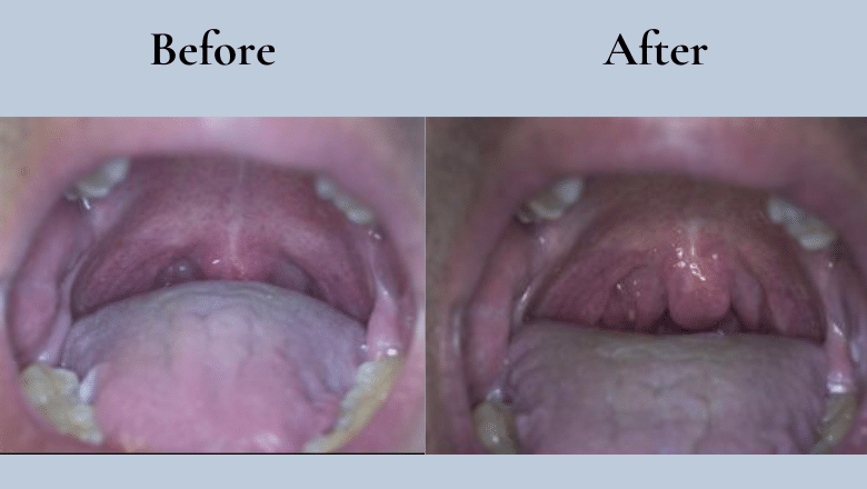 laser snoring treatment before after 1