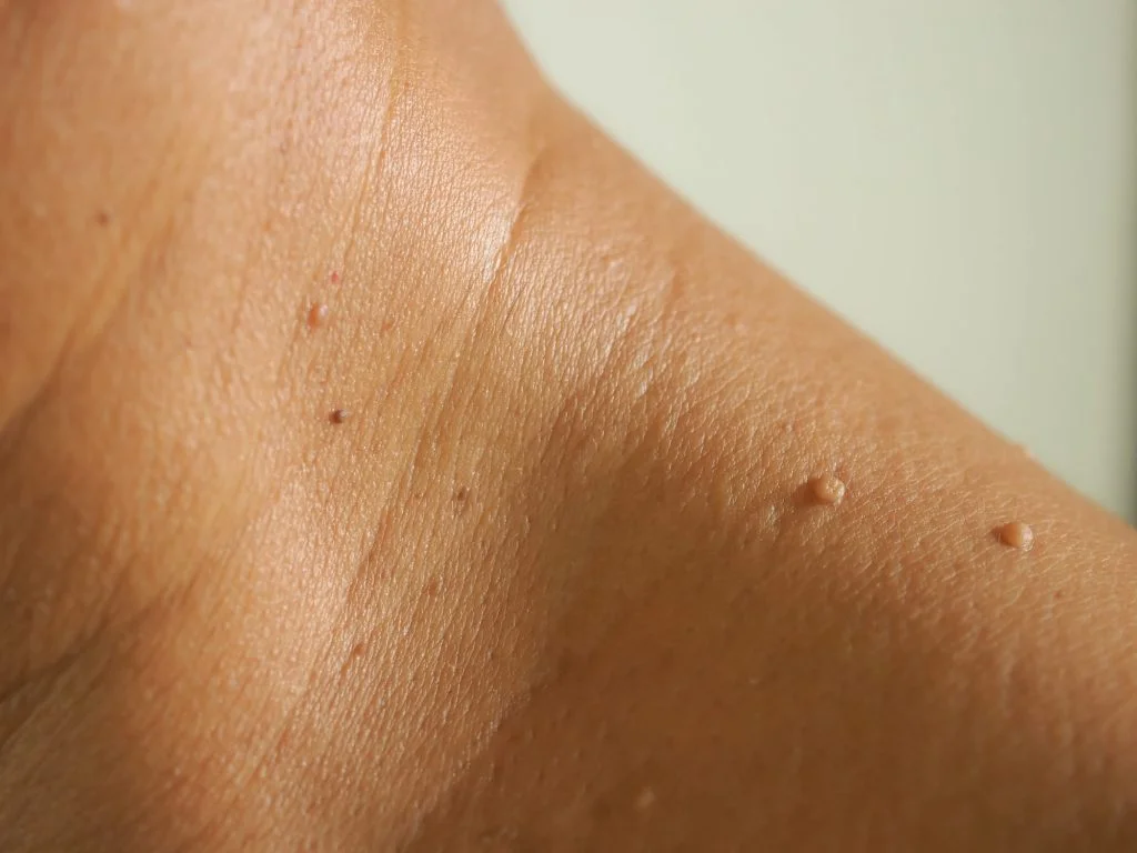 skin tag removal london UK