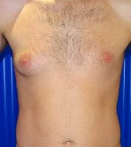 gynecomastia before