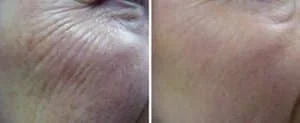 non surgical facelift