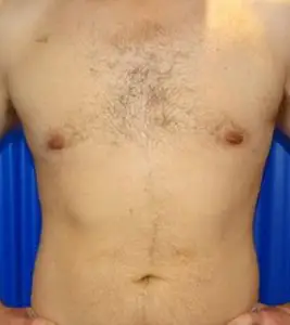 male breast reduction after