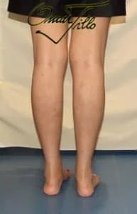 calf fat transfer after