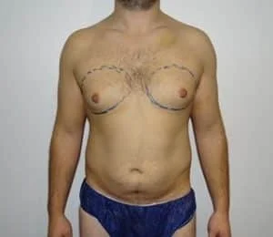 male breast reduction gynecomastia correction before