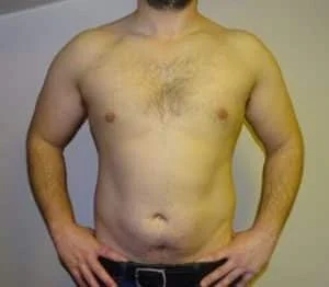 male breast reduction gynecomastia correction after