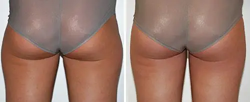 laser lipo before and after