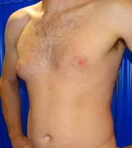 gynecomastia london before