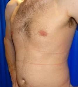 gynecomastia london after