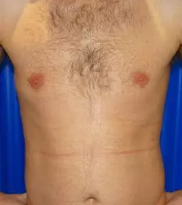 gynecomastia after