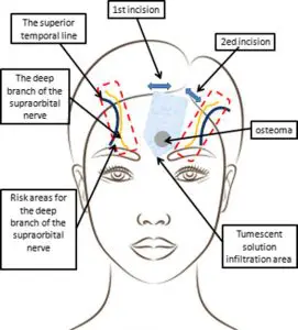 forehead osteoma removal