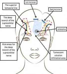 forehead osteoma removal