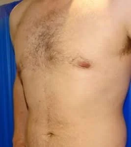 male chest reduction side view after