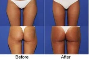 thigh liposuction results