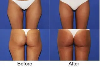 thigh liposuction results