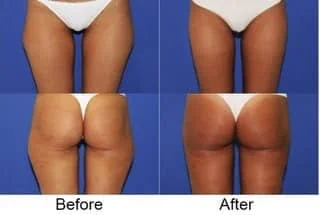 High Definition Liposuction London