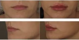 lip fillers before and after