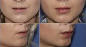 lip fillers cost