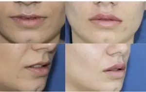 lip fillers london