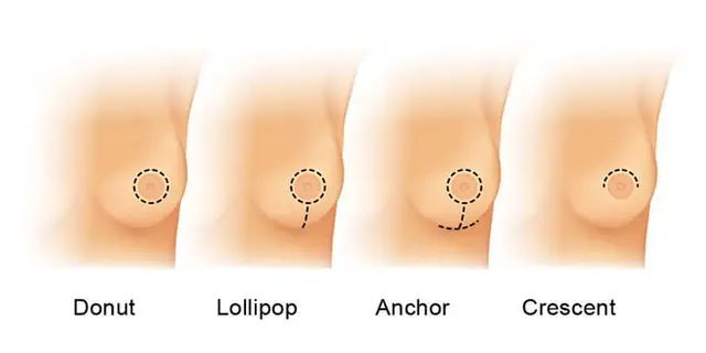 Breast Lift Incision Techniques