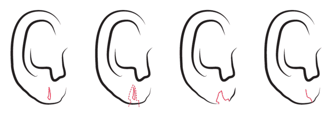 split earlobe repair