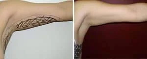 arm liposuction results