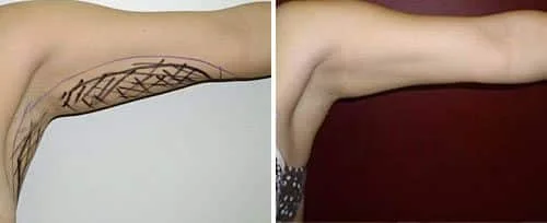 arm liposuction results